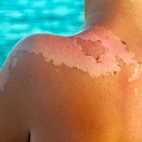 How Long Does a Sunburn Last and Is There Any Way to Make It Heal Faster? - News Without Politics