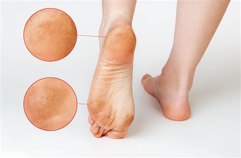 Circle Callus On Bottom Of Foot Flash Sales | emergencydentistry.com