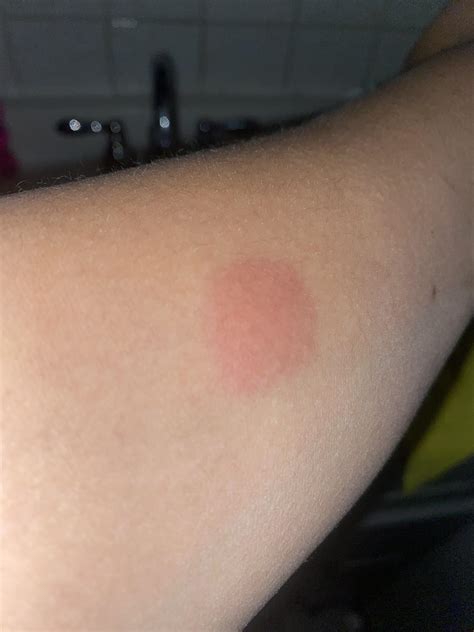 Does this look positive.? : r/Tuberculosis