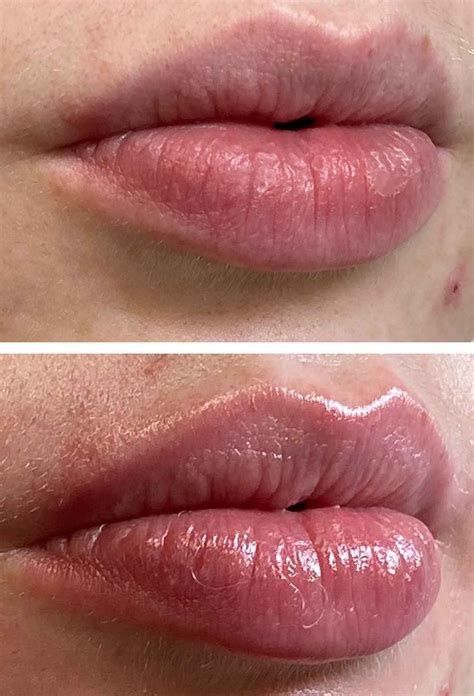 The Truth About Microneedling Your Lips