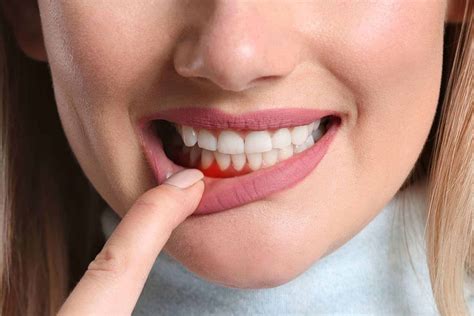 The Guide to Gingivitis: What It Is and How to Treat It
