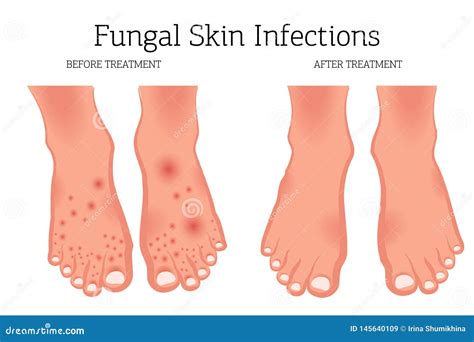 Feet With Fungal Nail Infection Vector Illustration | CartoonDealer.com #130428116