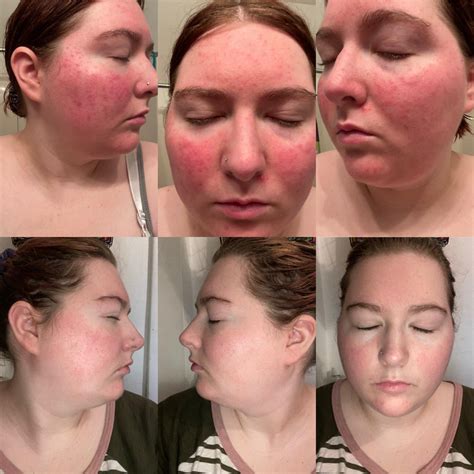 This is my before and after of just a month using metrogel for my rosacea! : r/Rosacea