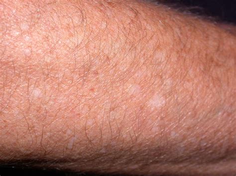 White Spots on Skin: Causes, Treatments, and Seeking Care