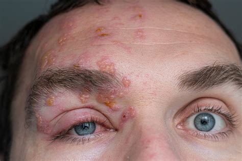 Shingles (Herpes Zoster) - Katu Dermatology Clinic