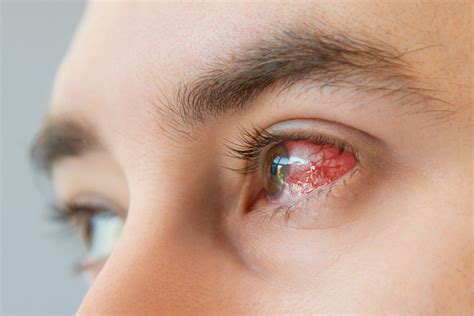 Retinal Hemorrhage Treatment in Baton Rouge, LA