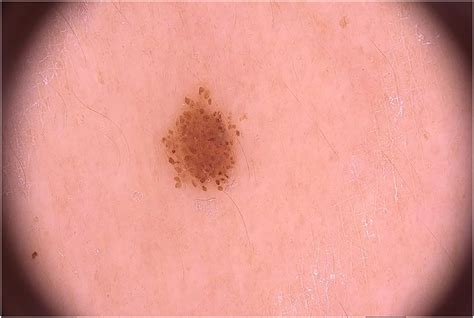 Benign Melanocytic Nevi