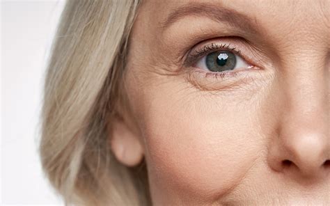 Crows Feet Treatment - Bellissimo Clinic