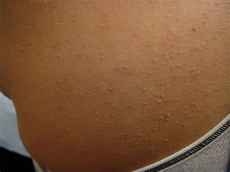 Red Bumps On Arms Keratosis Pilaris at Clifford Castleberry blog