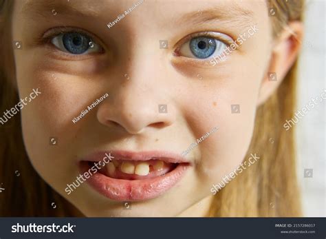 Malocclusion Large Front Teeth Young Children Stockfoto 2157286017 ...