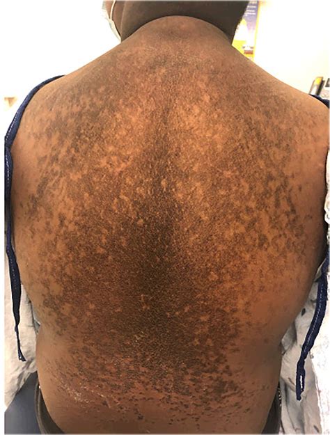 Disorders in Children - Dermatologic Clinics