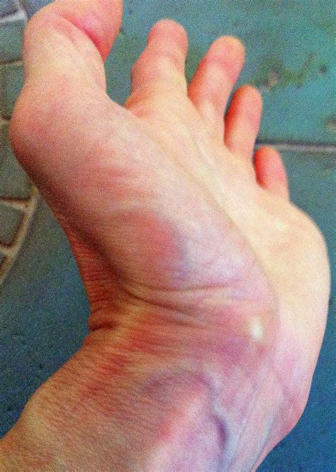 What To Do When A Ganglion Cyst Ruptures Orthobethesda