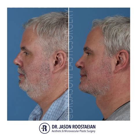 Jawline Surgery Men Facial Plastic Surgery For Men Before And After