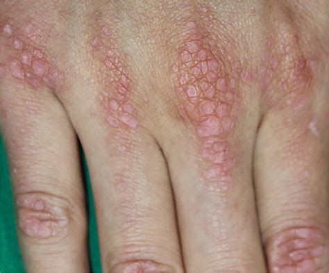 Erythematous Papules on Dorsum of Both Hands | AAFP