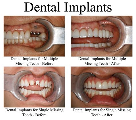Dental Implants