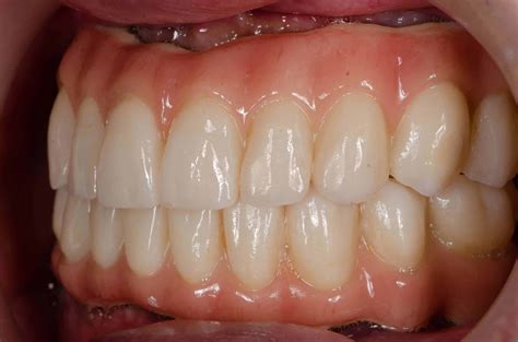 Loose Teeth in Adults | When to Worry & What to Do