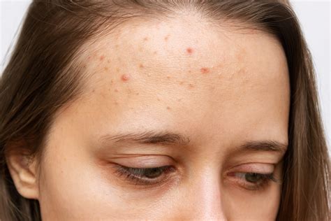Acne Treatment Clinic | Ava MD