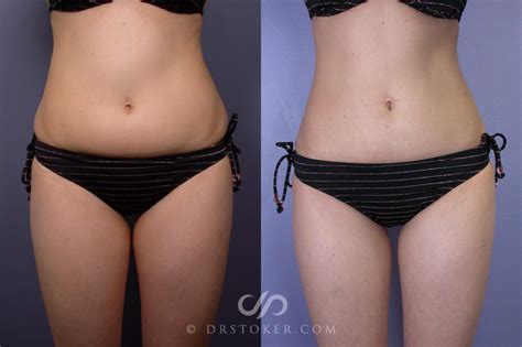 Liposuction Procedure And Recovery