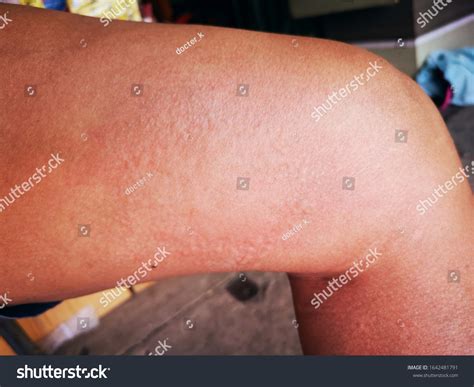 123 Thigh Acne Images, Stock Photos & Vectors | Shutterstock