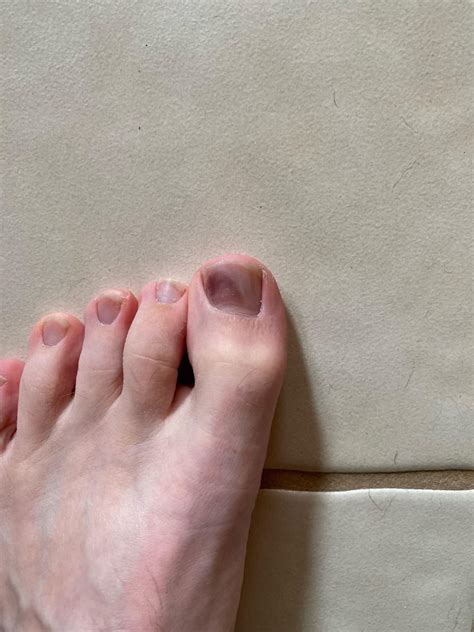 Bruised toe? : r/RunningShoeGeeks