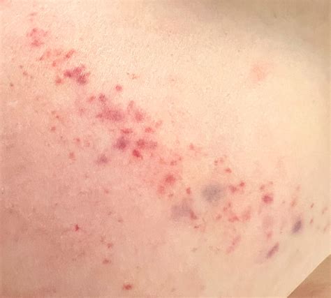 Types Of Chest Rashes at Sherlyn Weyer blog
