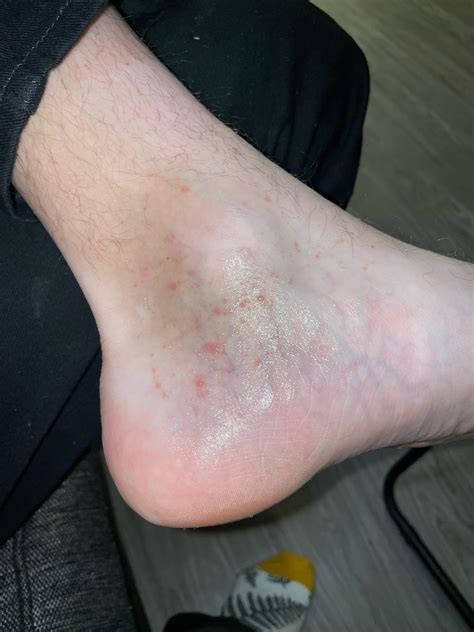 My boyfriend (26m) has this small bumps on his foot for months. What is it? : r/skin