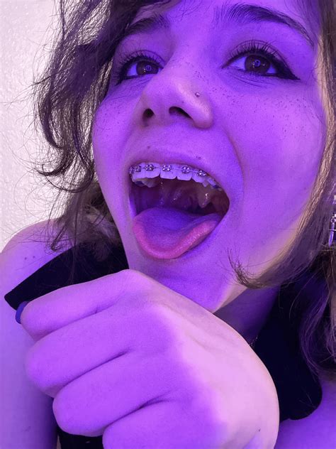 open wiiide :D : r/Amature_Braces