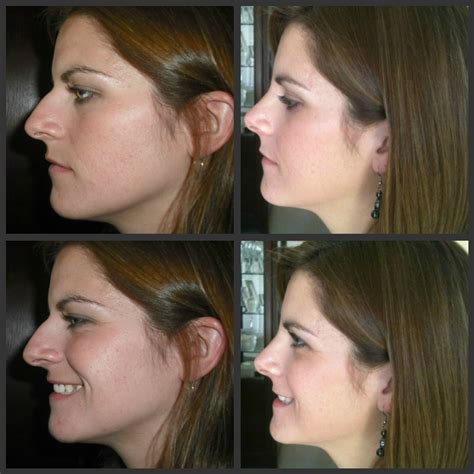 Nose Job Recovery Timeline at Michael Stover blog