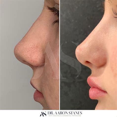 Pin by Lærke on lips | Nose job, Nose fillers, Rhinoplasty nose jobs