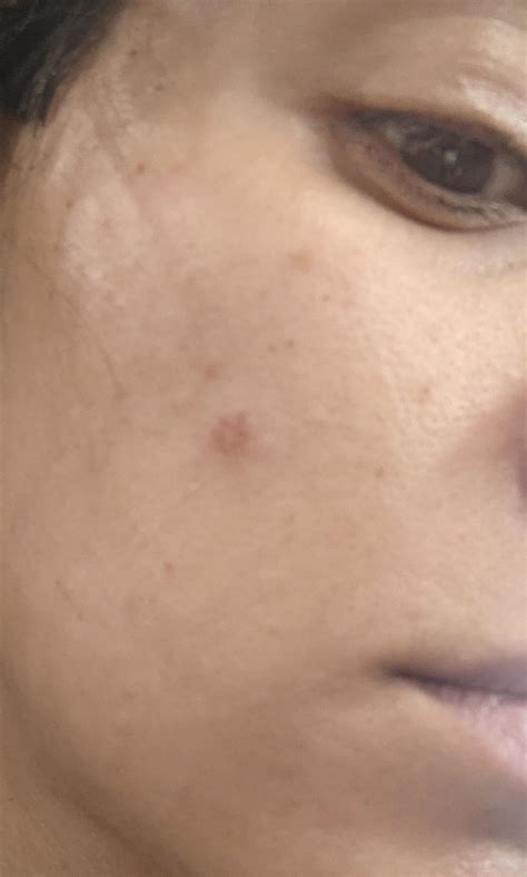 Got a facial etch burn (phosphoric acid) today at the dentist. What can ...