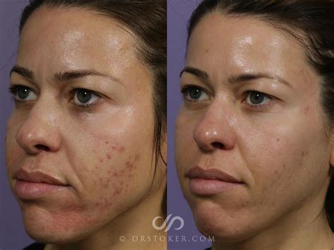 Microneedling Before and After Pictures Case 1857 | Los Angeles, CA | Stoker Aesthetics