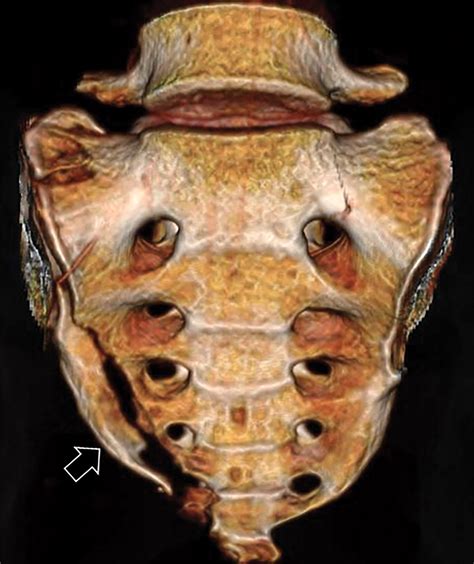 CT of Sacral Fractures: Classification Systems and Management | RadioGraphics