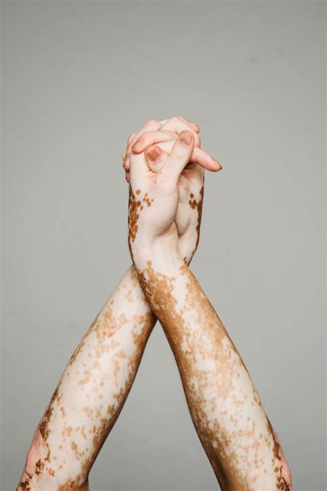 Causes of Vitiligo in Adults - Healthier Steps - what causes vitiligo