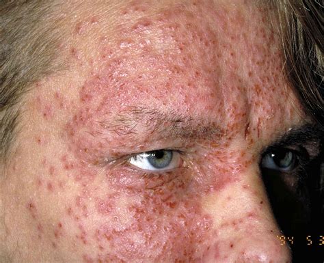 Eczema Face Rash Pictures at Joan Fleming blog