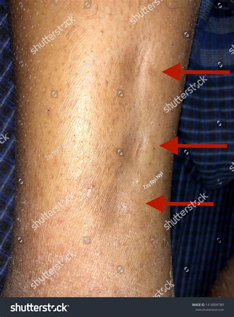 Arrow Indicating Mild Pitting Oedema Leg Stock Photo 1418099789 ...