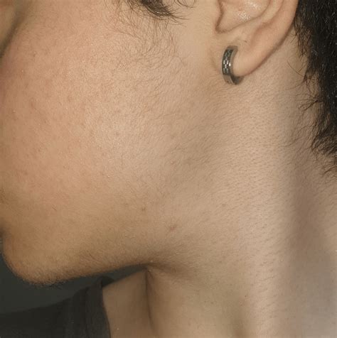 update on peach fuzz! 1 month on T, it's less visible without using the ...