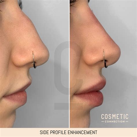 Side Profile Enhancement | Nose job, Nose fillers, Pretty nose