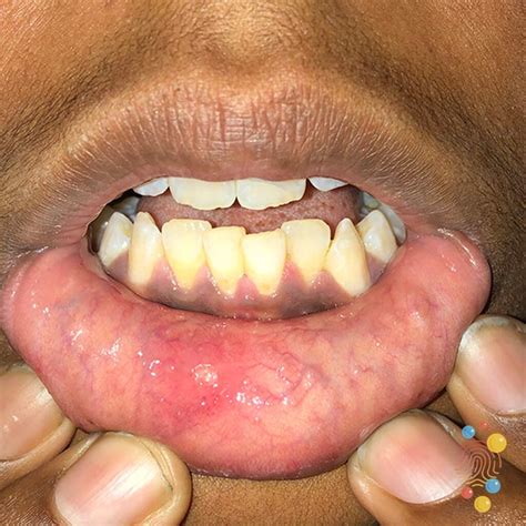 aphthous ulcer: canker sore swollen lip – FSNUGF