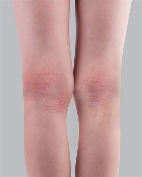 Comprender el eczema en los adultos | Fundación Eczema