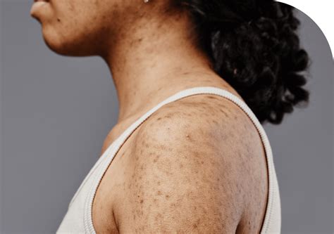 Get a Hyperpigmentation Cream Prescription Online