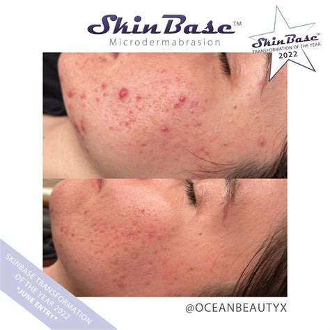 Top 6 benefits of Microdermabrasion for Acne