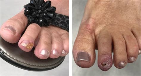 Signs Of Skin Cancer On Toenails at Sharon Conner blog