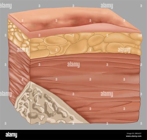 Bedsore Stage 1 Image