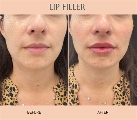 Where to Inject Botox for a Lip Flip: Complete Guide to Procedure, Benefits, and Costs - Ayana ...