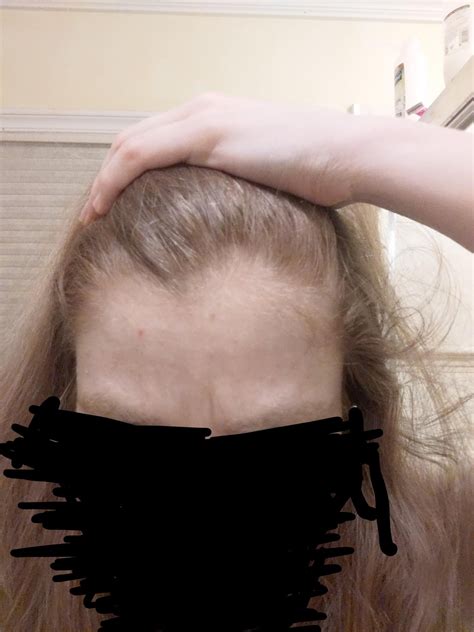 I have Hashi's and chronic iron deficiency -- doctors give conflicting diagnoses on AGA. What's ...