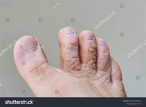 Toe Knuckle Callus Treatment at Mark Bevill blog