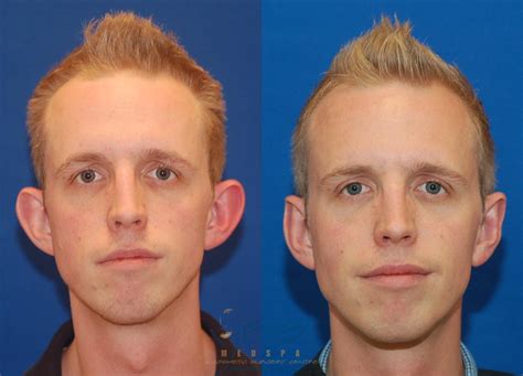 Otoplasty Procedure Video