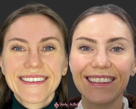 Getting Botox Injections In Your 20s and 30s - Everything You Need To Know