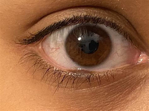 I have a birthmark in my eye’s waterline. : r/mildlyinteresting