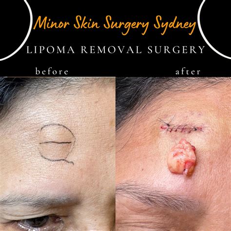 Lipoma Removal Surgery